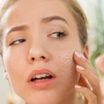 Expert Dermatology in Delhi: Acne Scar Solutions at Monaris Clinic