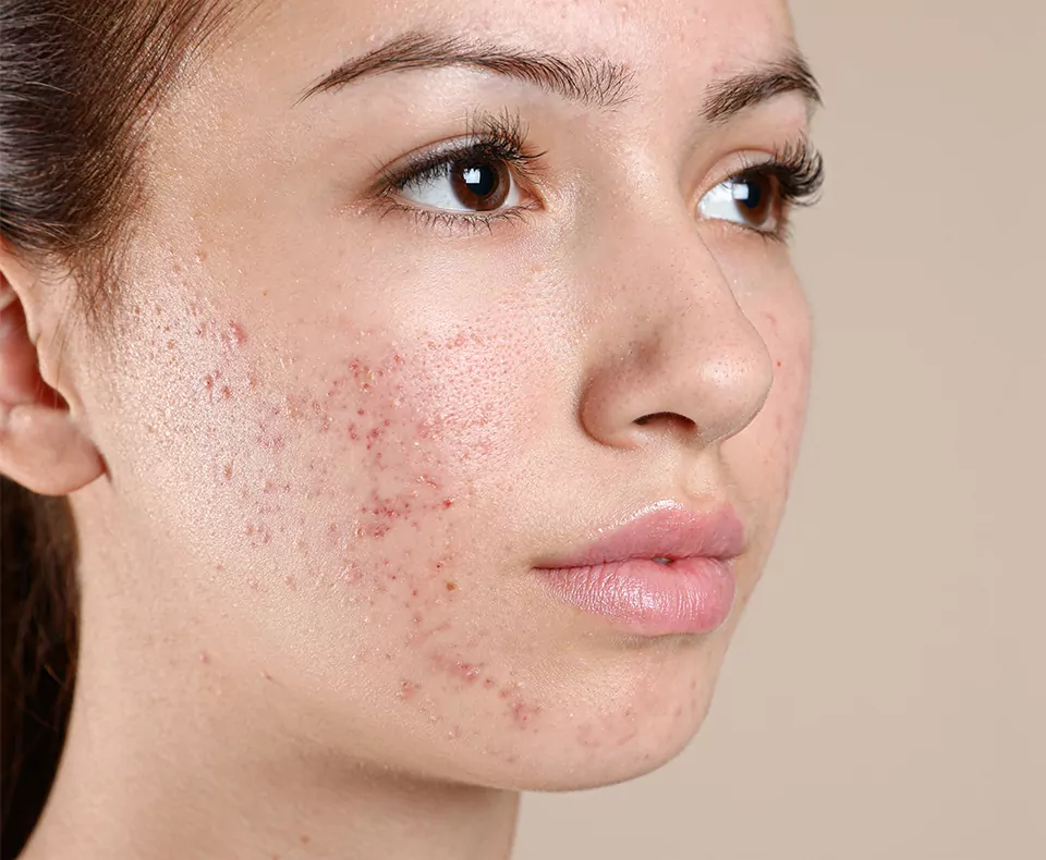 Patient skin before scar treatment